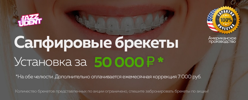 Как выбрать клинику для установки брекетов в рассрочку?