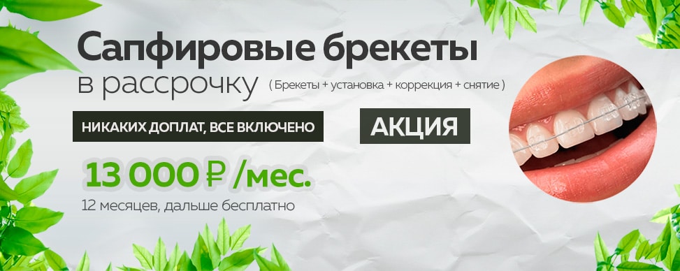 Что учесть при заключении договора на рассрочку для брекетов?