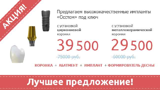 Имплант зубов. 